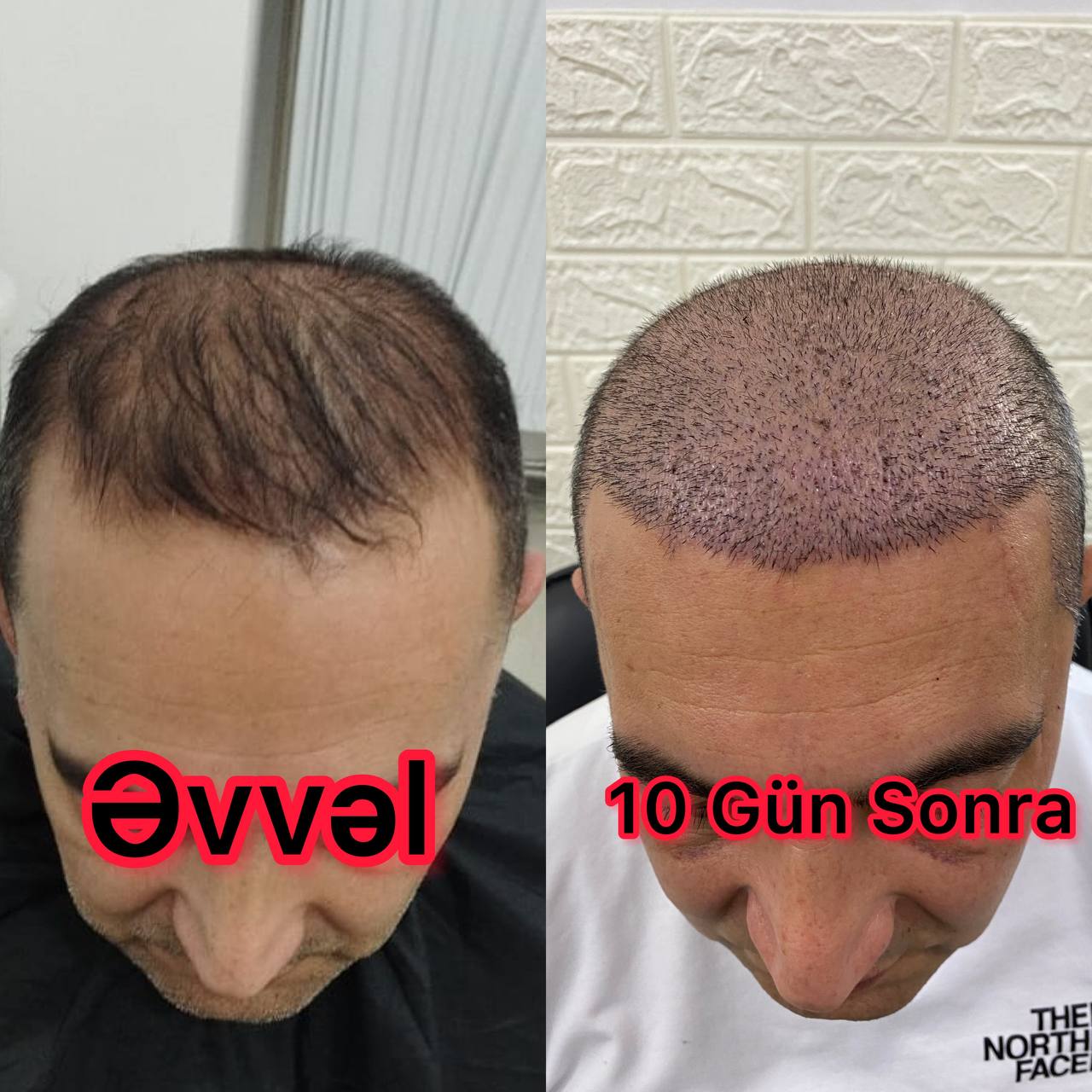 Əvvəl-Sonra